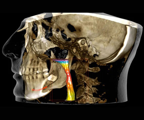 Planmeca Romexis: 3D-Bildgebung Atemwegsanalyse
