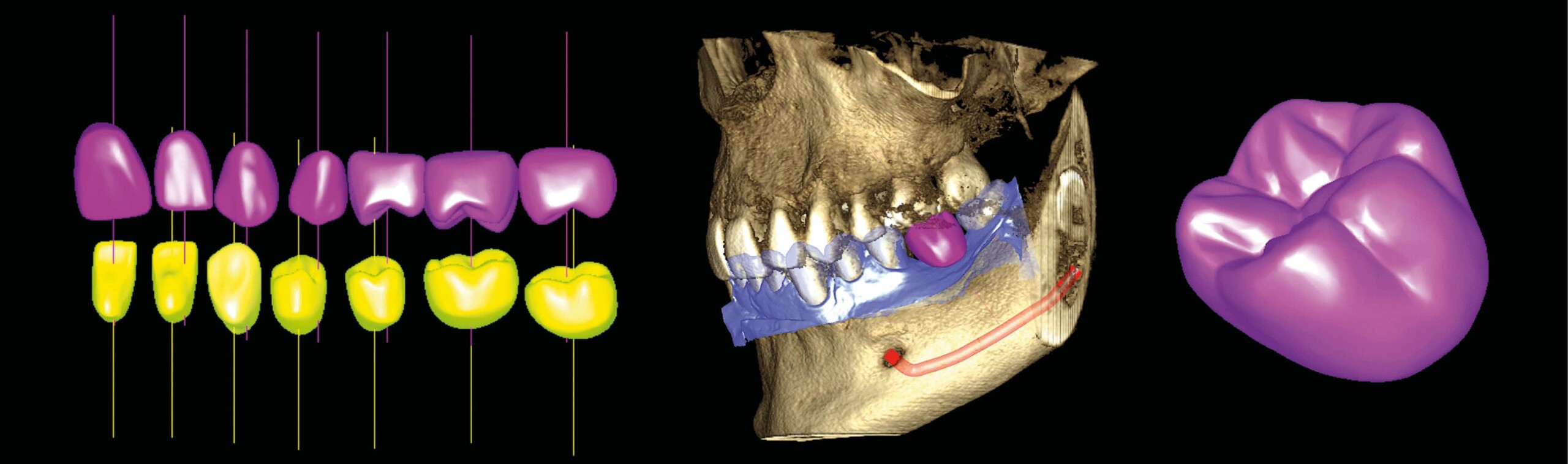 Planmeca Romexis Software Implantat-Arbeitsablauf