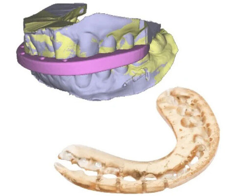 Planmeca Romexis: Erstellung von temporären und finalen Schienen
