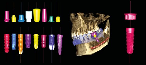 Planmeca Romexis Software Implantat-Arbeitsablauf