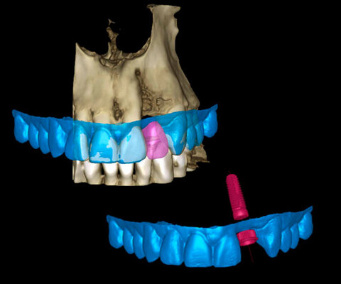 Planmeca Romexis Software Implantologie