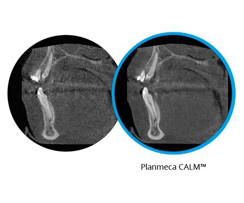 Planmeca ProMax 3D Mid - 3D-Bildgebung mit Korrektur von Patientenbewegungen