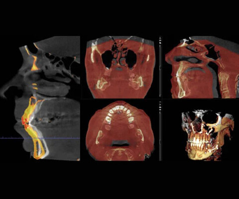 Planmeca Romexis: Überlagerung von DVT-Aufnahmen