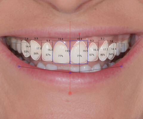 Planmeca Romexis Software Smile Design