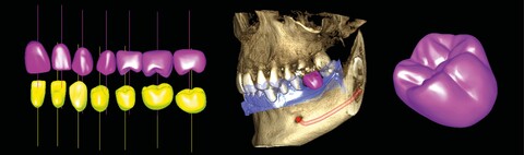 Planmeca Romexis Software Implantat-Arbeitsablauf