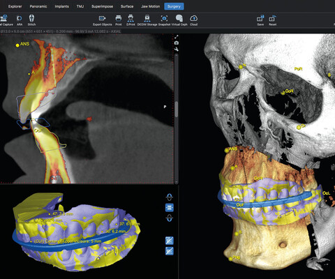 Planmeca Romexis Software CMF Surgery