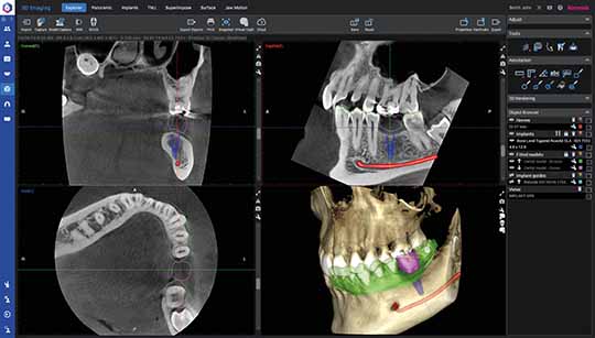 Planmeca Romexis Software fortschrittliche Implantat-Arbeitsablauf