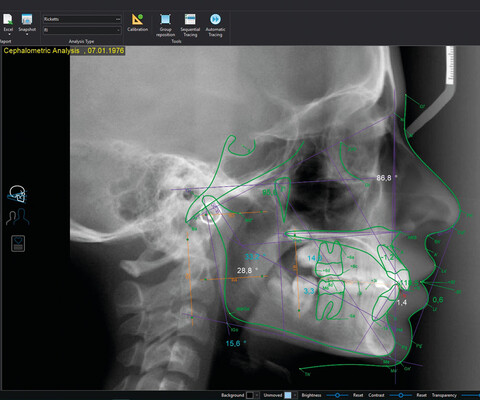 Planmeca Romexis Software Fernröntgenanalyse